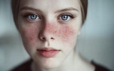 Lupus eritematoso sistémico: me pasaba los días llorando