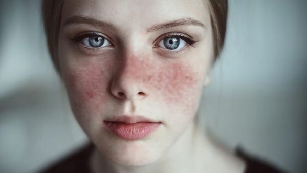 lupus eritematoso sistémico