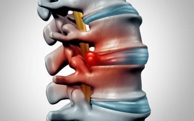 Para tratar hernias discales la quiropráctica muestra más eficacia que las infiltraciones nerviosas. Y es más barata!!