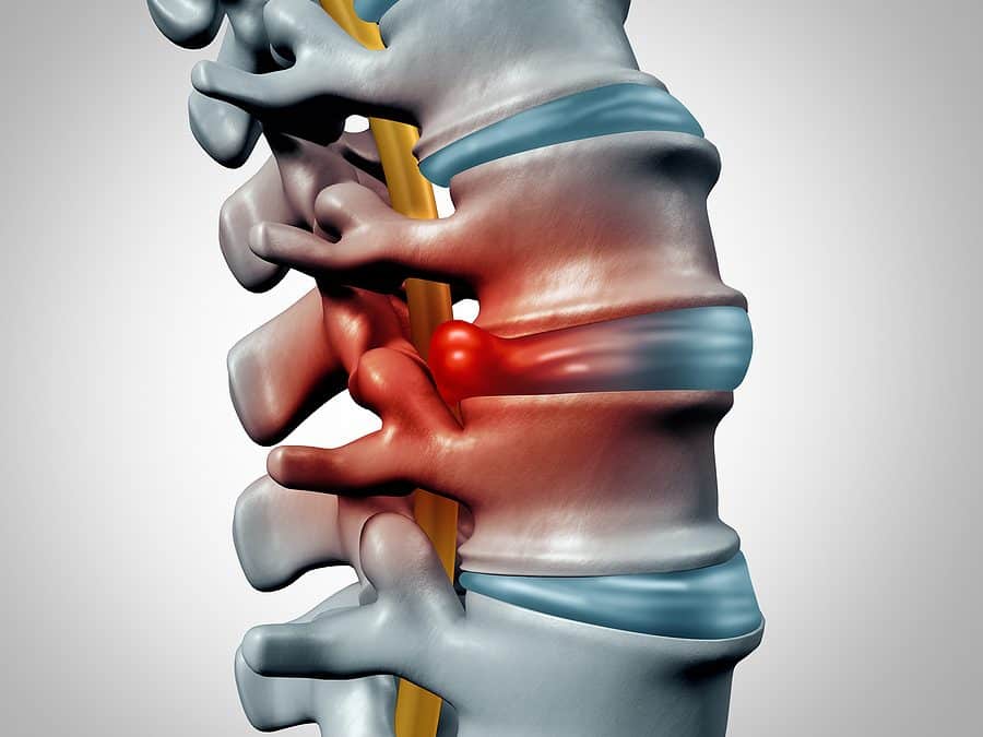 Para tratar hernias discales la quiropráctica muestra más eficacia que las infiltraciones nerviosas. Y es más barata!!