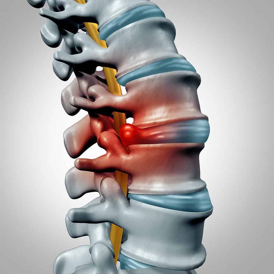 hernias discales quiropráctica hernias discales quiropráctica